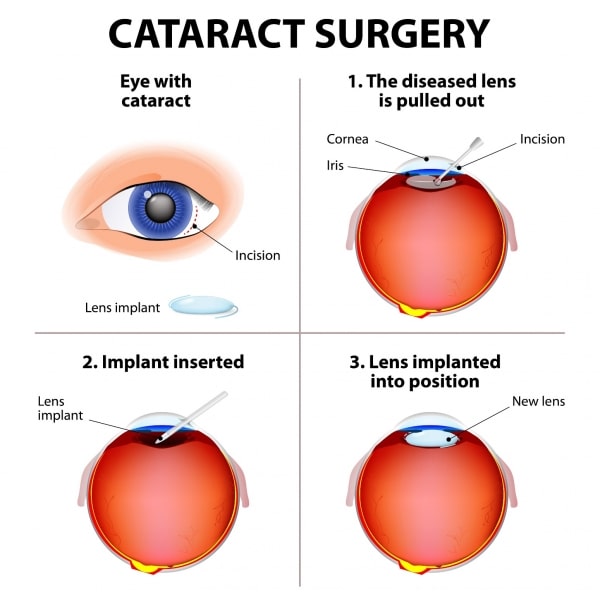 4 stages of cataract ophthalmic surgery including lens replacement being implanted