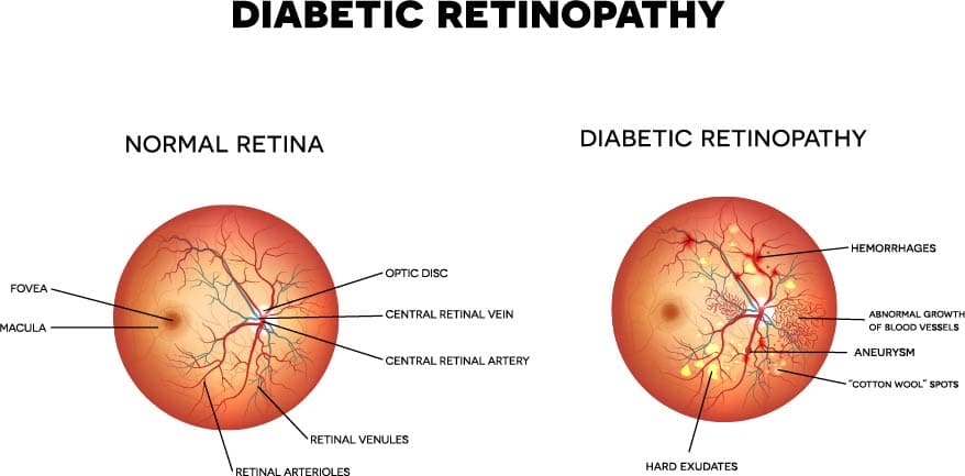diabetic retinopathy illustration