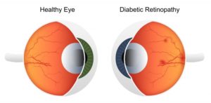 11 warning signs that you may have diabetic retinopathy 5e95b0084950a