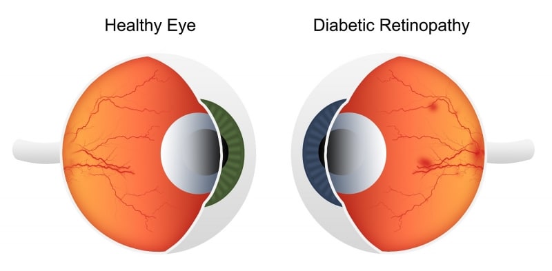 11 warning signs that you may have diabetic retinopathy 5e95b0084950a