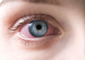 Image of irritated eye