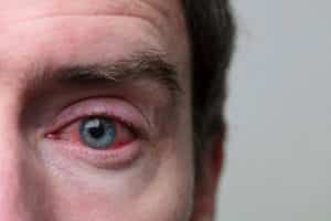Close up of a severe bloodshot eye