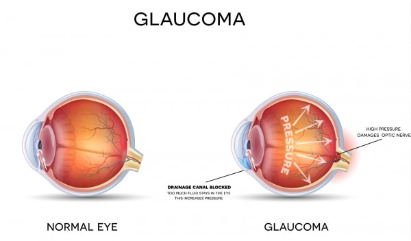 Symptoms of Glaucoma in Loveland, CO