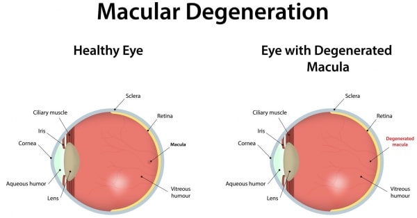 Macular Hole in Loveland, CO