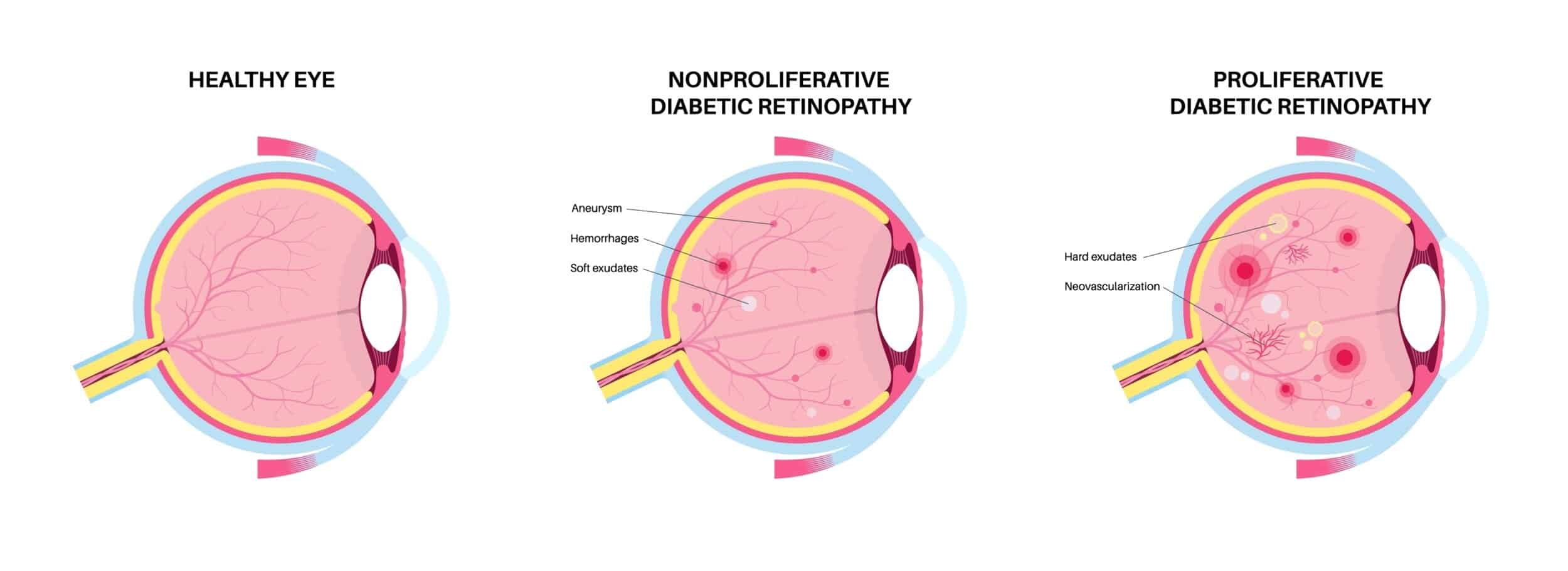 Illustrated diagram shows diabetic retinopathy in stages from early to late. Illustration also compares the condition to a normal healthy eye.