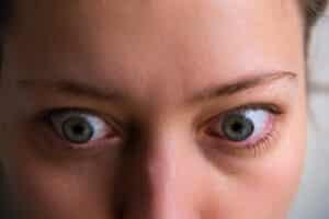 A close-up shot of a woman with thyroid eye disease’s eyes