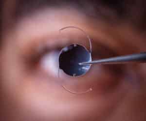 Close up of an eye with an IOL in Loveland, CO
