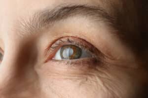 Close up of an eye needing cataract surgery in Loveland, CO