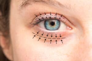 A closeup view on a woman's eyes with arrows showing the planned blepharoplasty for ptosis in Loveland, CO